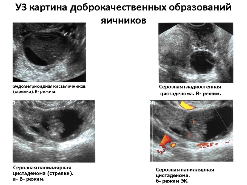 УЗ картина доброкачественных образований яичников Эндометриоидная киста яичников  (стрелки). В- режим.  Серозная